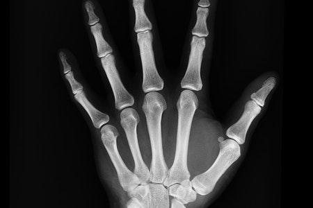 13,000 Patients’ PHI Breached Following Hand Rehabilitation Specialists Suffering Data Theft
